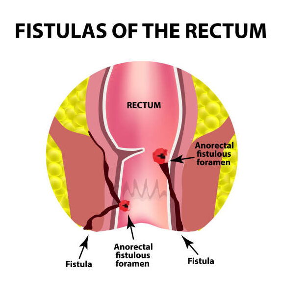 fistula-swami-satyanand-hospital
